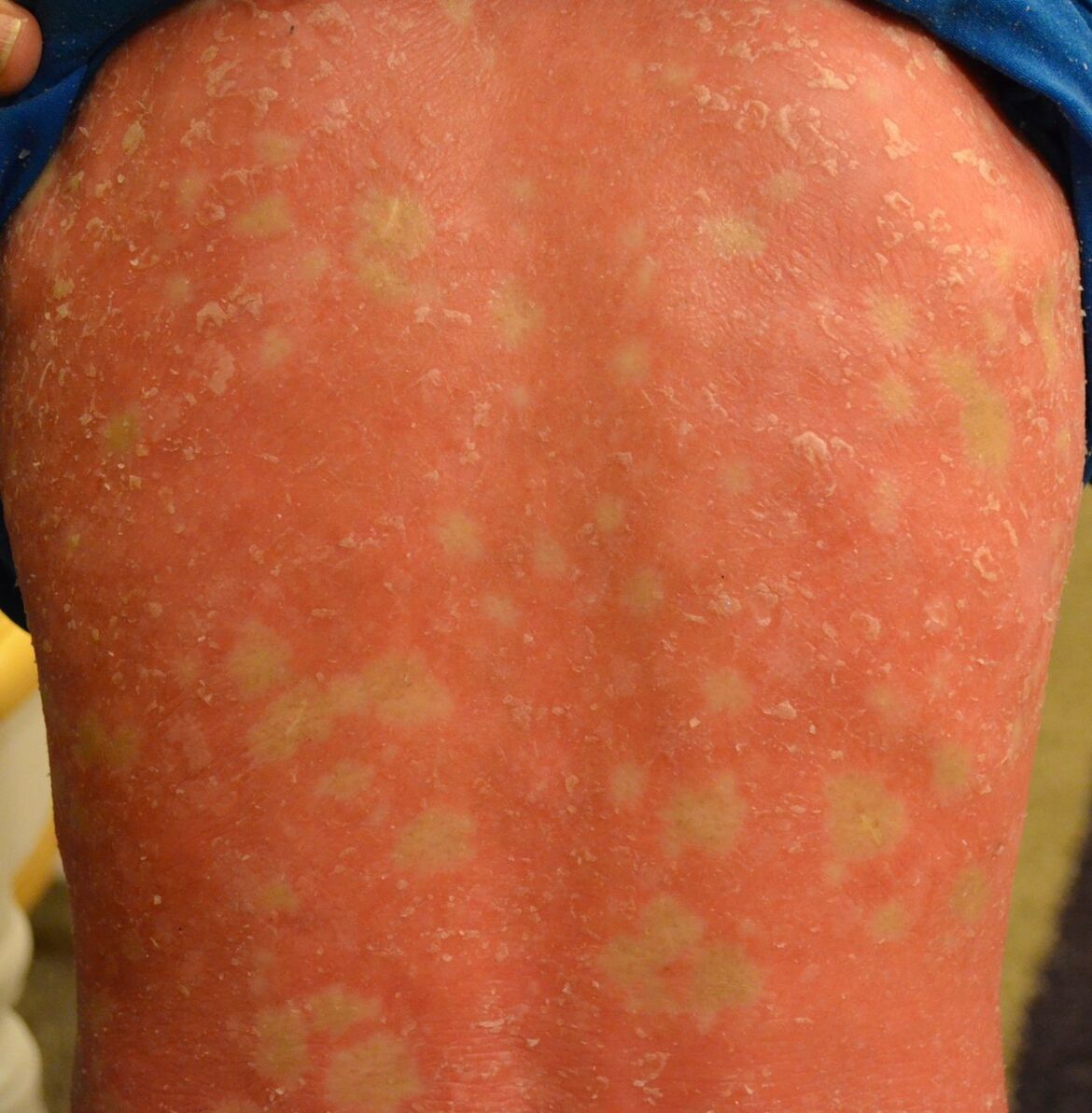 ICHTHYOSIS AYURVEDA MANAGEMENT