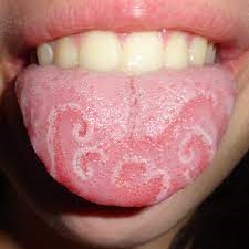 GEOGRAPHIC TONGUE
