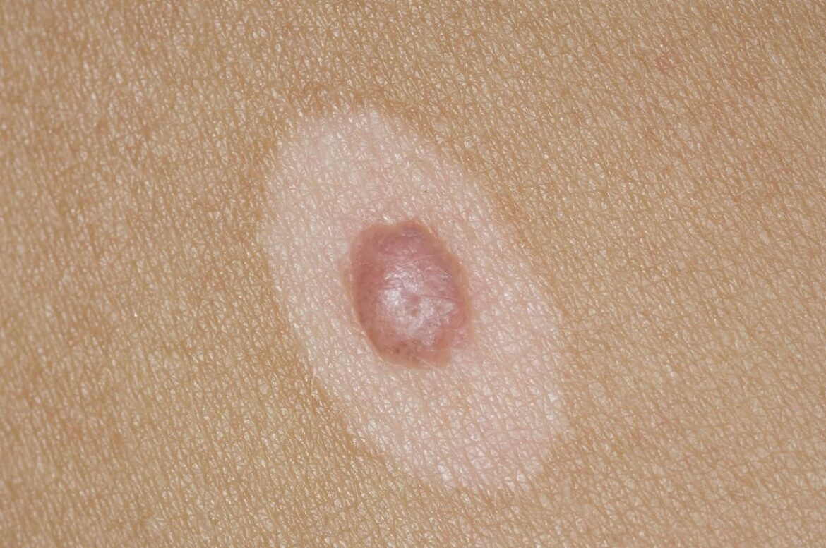 HALO NEVUS