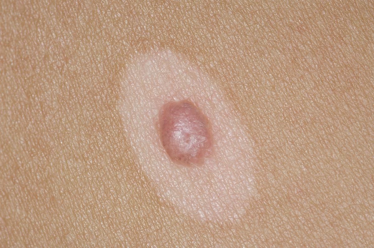 Halo Nevus | Chandigarh Ayurveda and Panchkarma Centre