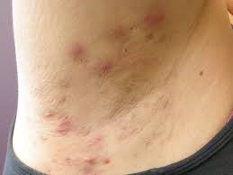 HIDRADENITIS SUPPURATIVA