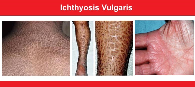 ICHTHYOSIS VULGARIS