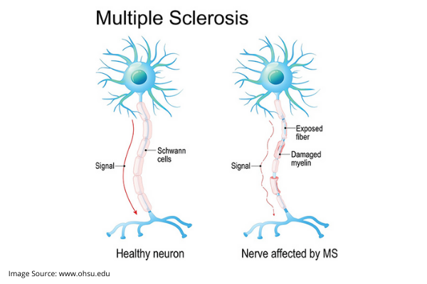 MULTIPLE SCLEROSIS TREATMENT ACCORDING TO AYURVEDA