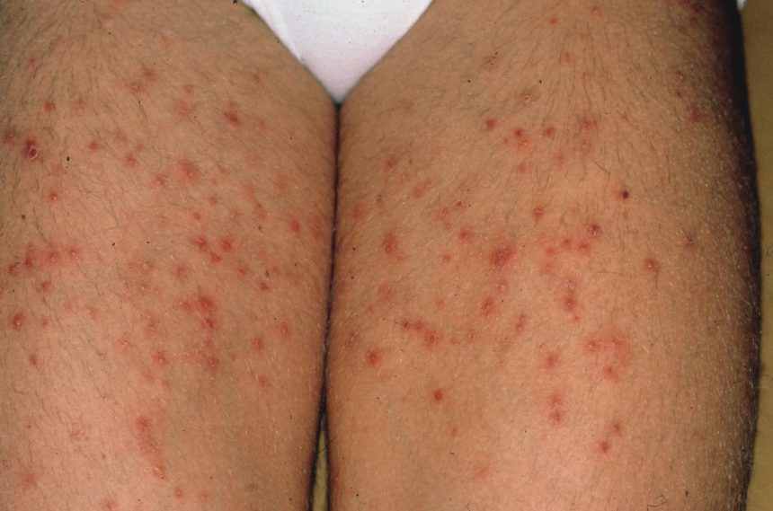 Folliculitis