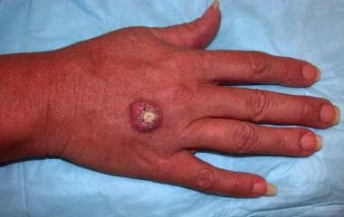 KERATOACANTHOMA