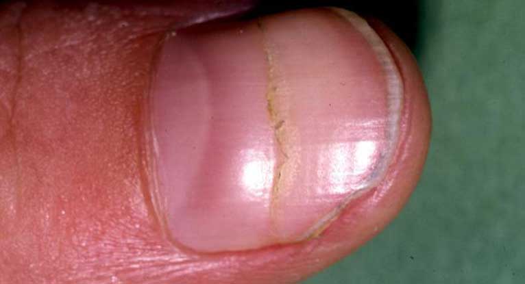 Nail Disorder