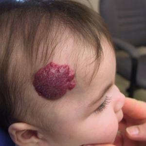 Hemangioma | Chandigarh Ayurved & Panchakarma Centre