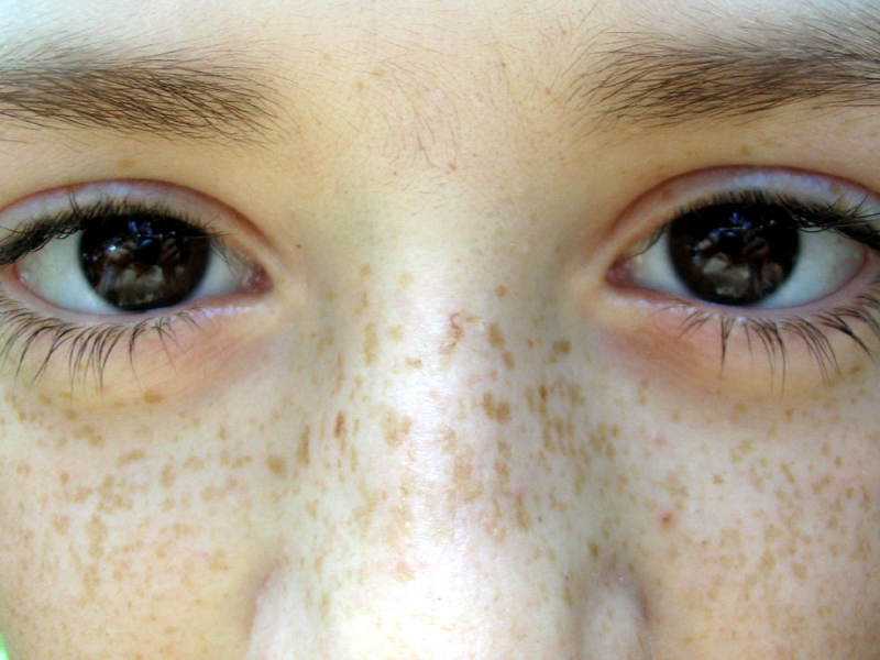 Home Remedies To Get Rid Of Freckles