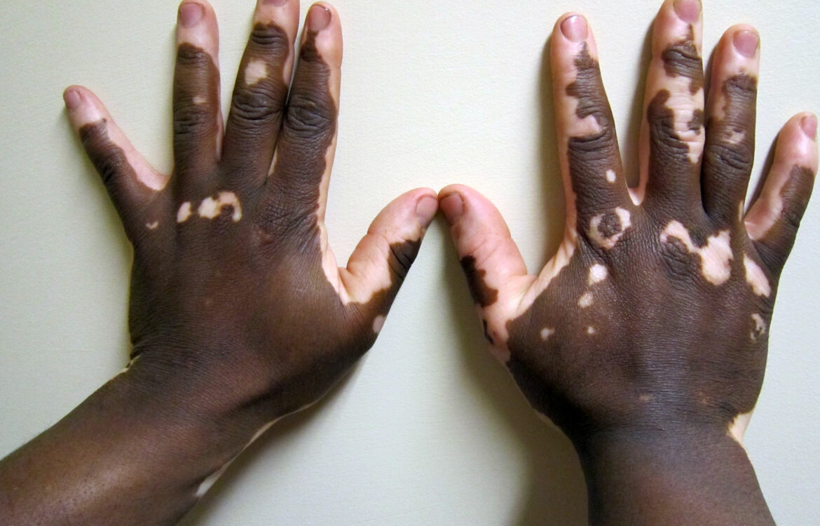 Vitiligo