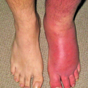 CELLULITIS