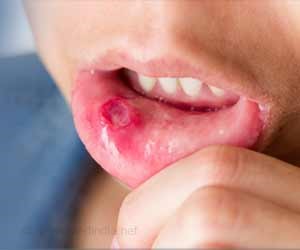 Home Remedies For Mouth Ulcers
