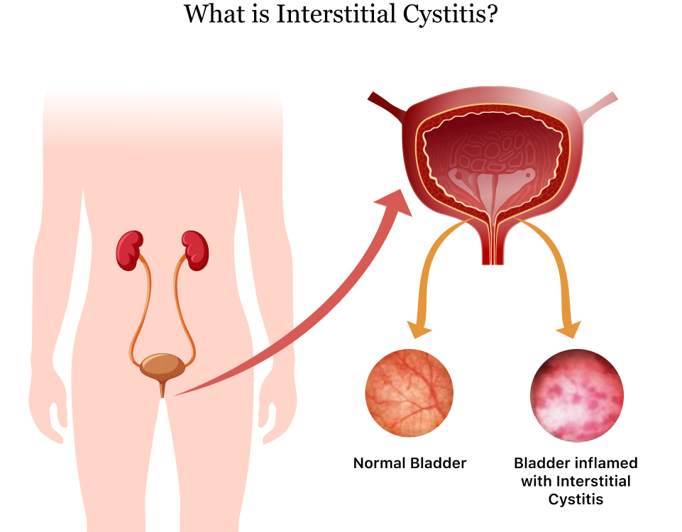 Best Herbal Remedies for Interstitial Cystitis