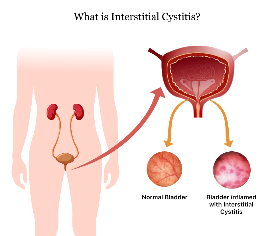 Best Herbal Remedies for Interstitial Cystitis