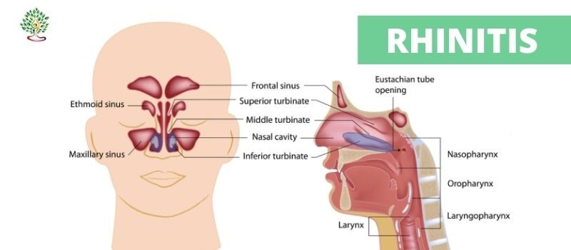 Home Remedies for Rhinitis