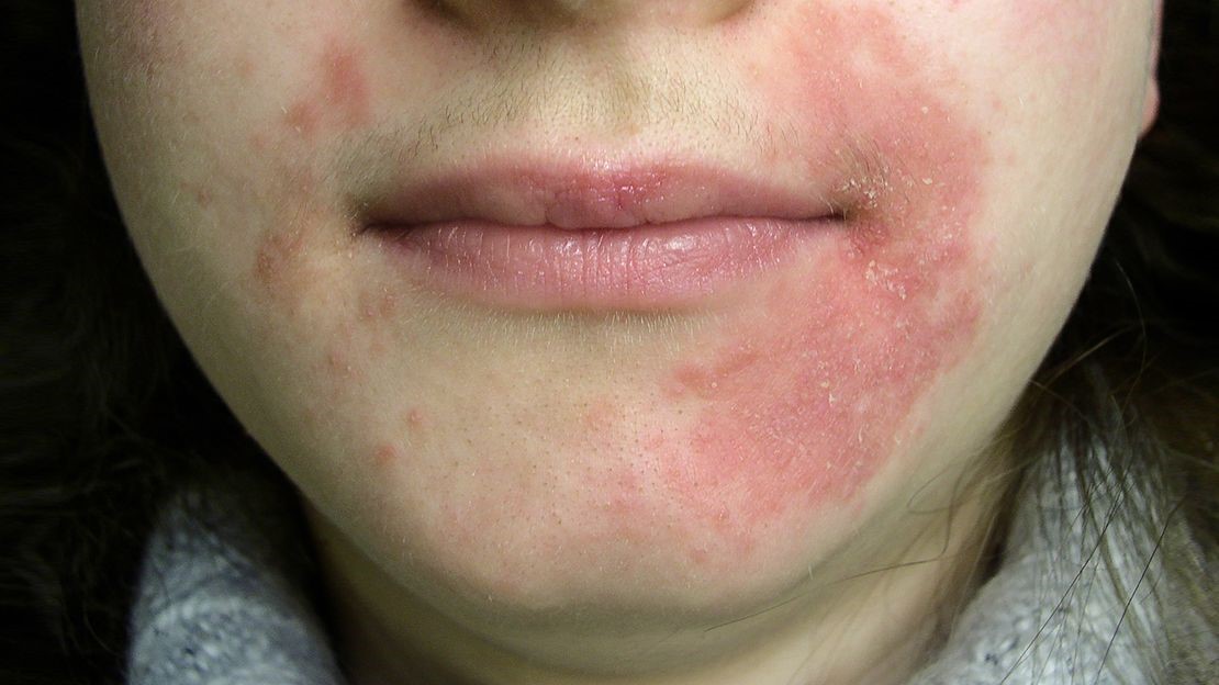 Periorificial Dermatitis