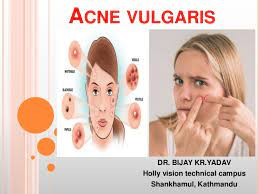 ACNE (ACNE VULGARIS)