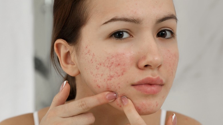 How To Treat Pimples Naturally And Quickly?