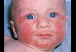  ECZEMA (ATOPIC DERMATITIS)