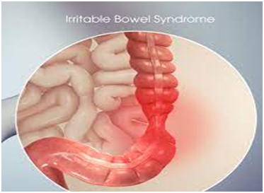 Irritable Bowel Syndrome pictures