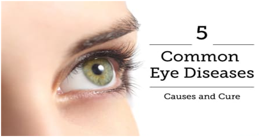 THE FIVE MOST COMMON EYE DISORDERS