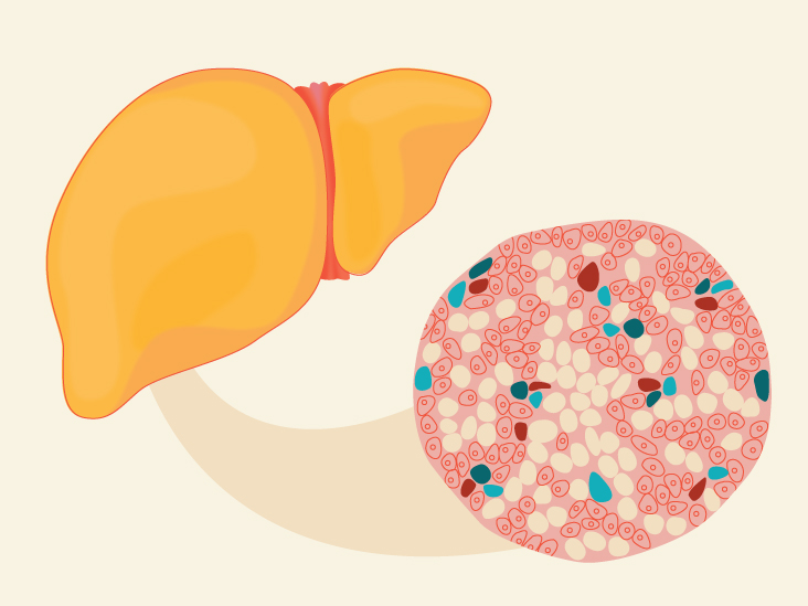 WHAT FOODS CAUSES FATTY LIVER Chandigarh Ayurved Panchakarma Centre WHAT FOODS CAUSES FATTY LIVER Chandigarh Ayurved Panchakarma Centre
