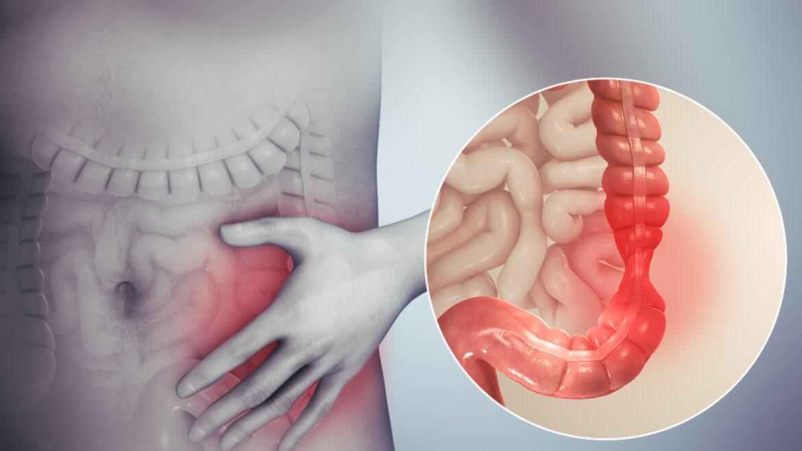 How To Deal with IBS Symptoms Naturally?