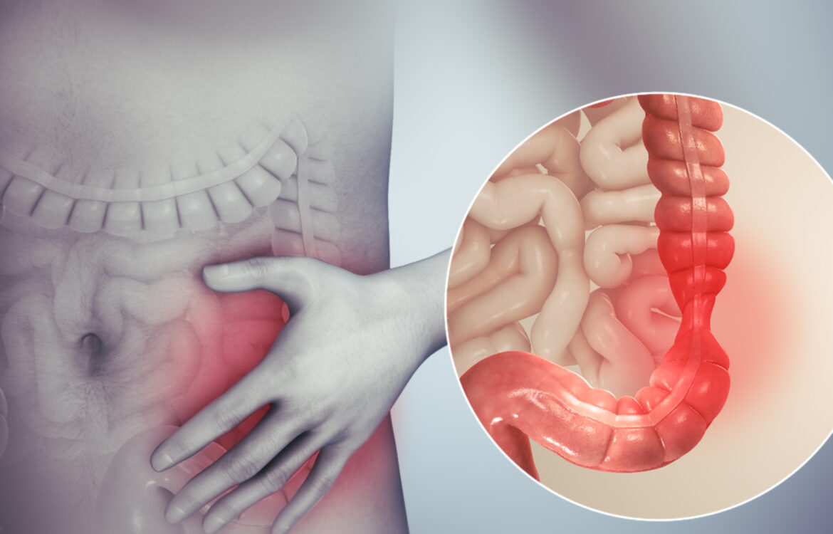 How To Deal with IBS Symptoms Naturally?