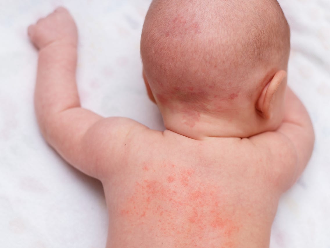 Rashes In Children Chandigarh Ayurved And Panchakarma Centre