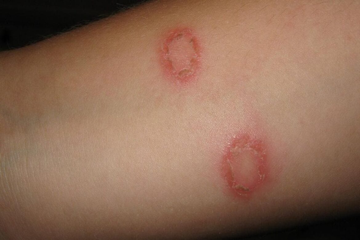 TINEA CORPORIS (RINGWORM OF THE BODY)  Chandigarh Ayurved & Panchakarma  Centre