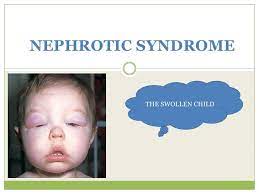 Nephrotic syndrome