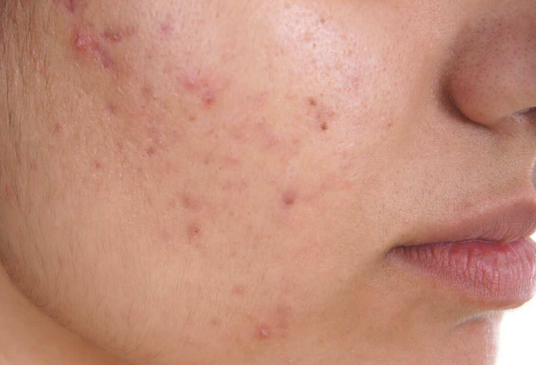 What is best treatment for pimples and acne?