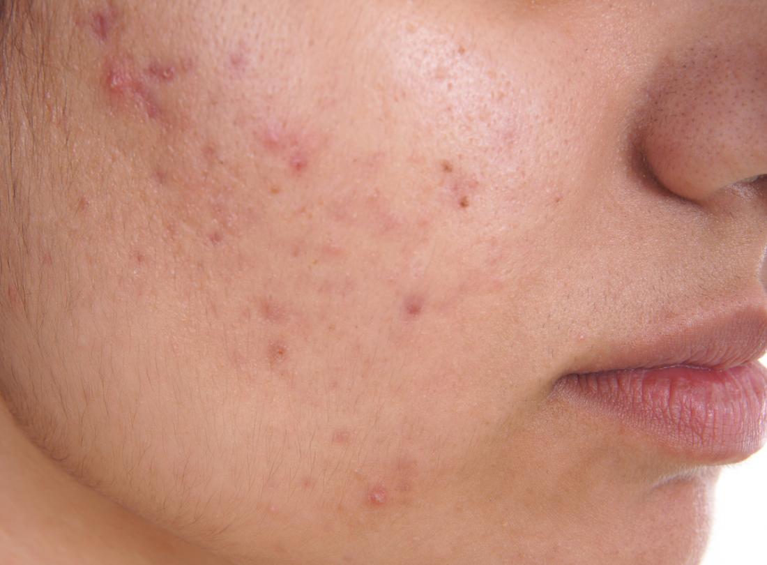 What is best treatment for pimples and acne?