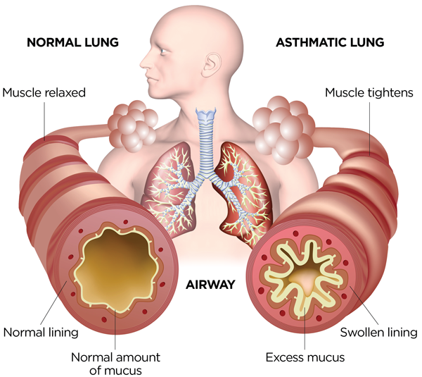 Best Home Remedies for Asthma