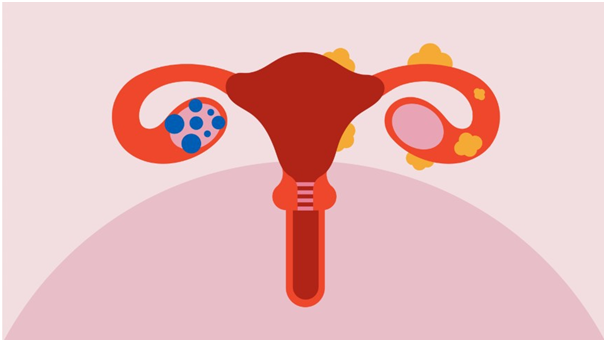 UNDERSTANDING THE DIFFERENCES BETWEEN PCOS AND ENDOMETRIOSIS