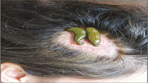 A Case Study of Leech Therapy Jalaukavacharana in Khalitya WSR Alopecia