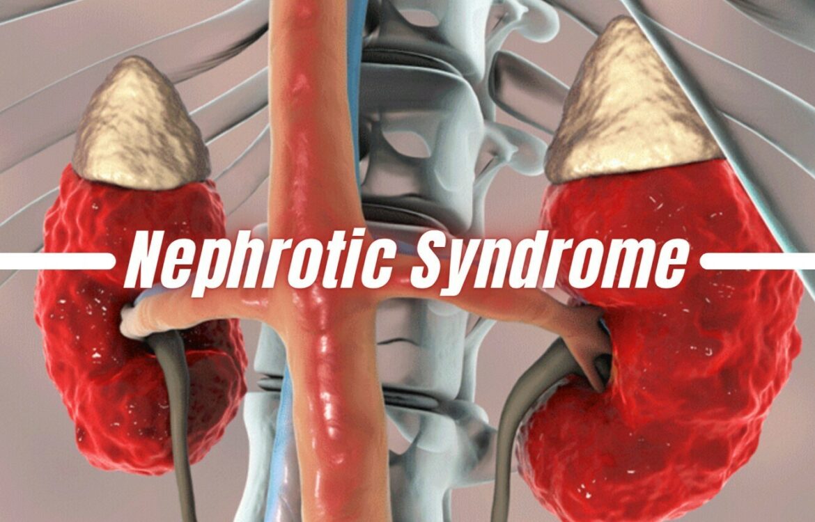 Nephrotic-syndrome