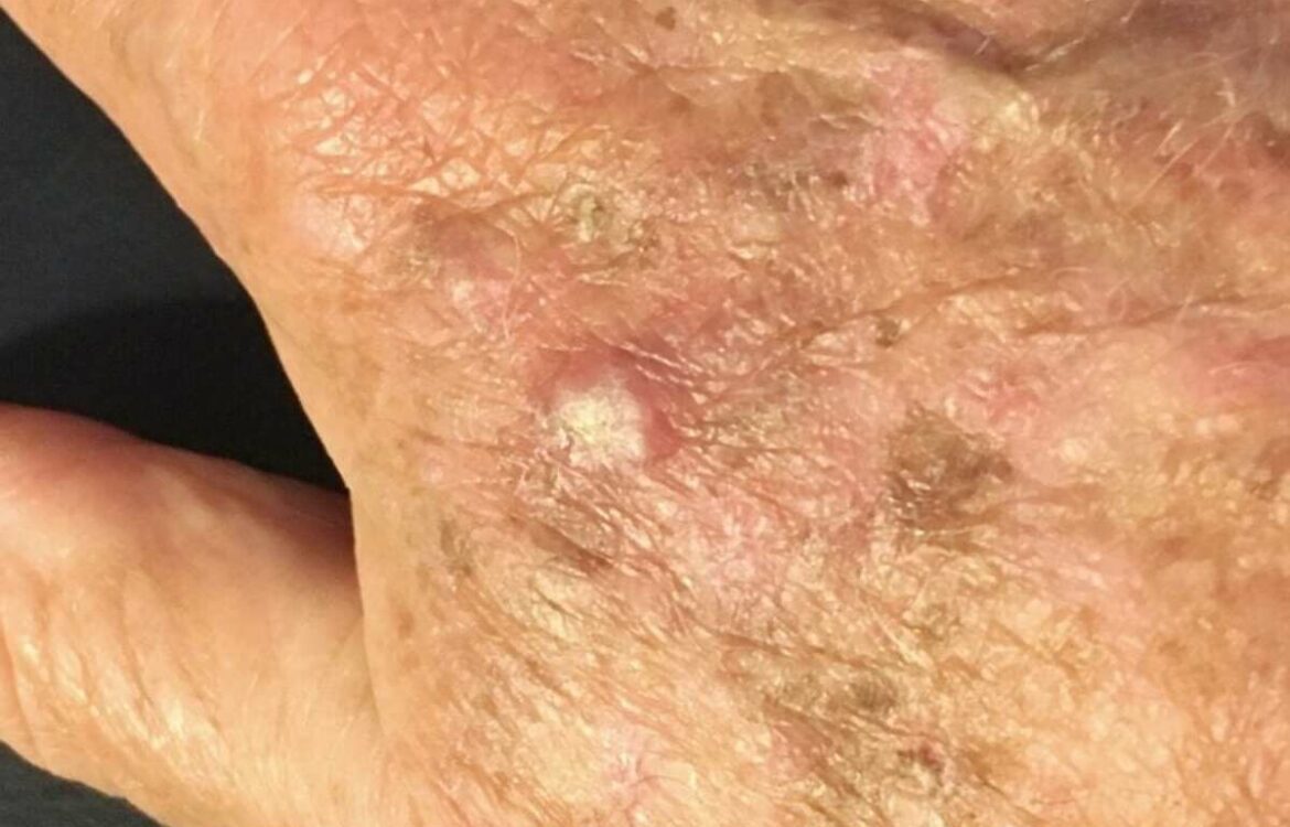 Actinic-Keratosis