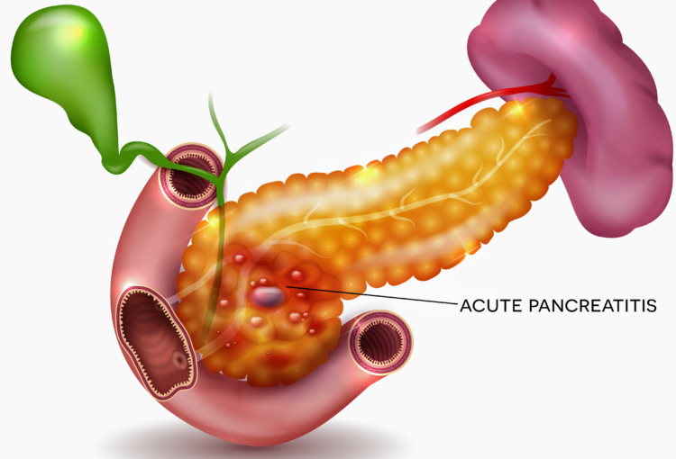 Pancreatitis