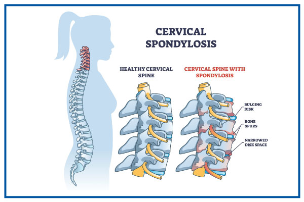 cervical-spondylosis-