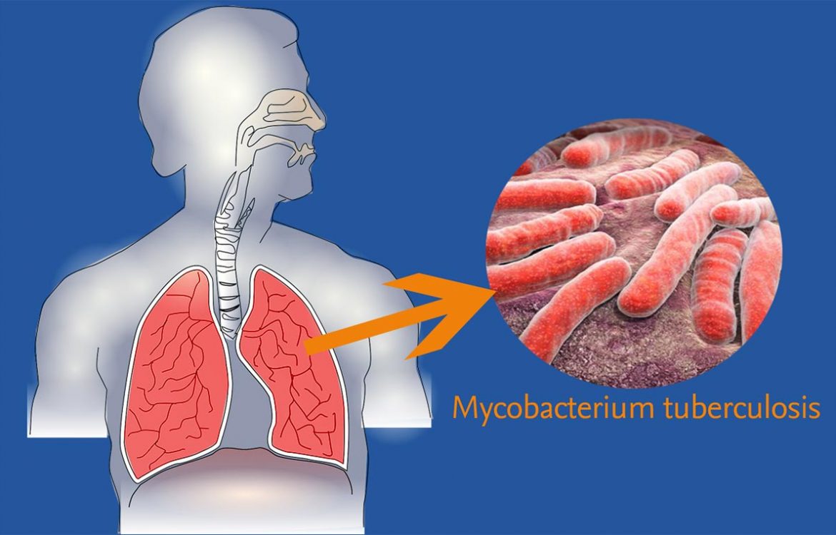 Tuberculosis