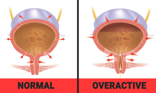OVERACTIVE BLADDER AND ITS AYURVEDIC MANAGEMENT