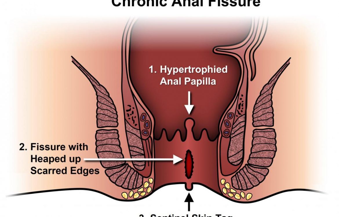 anal_fissure