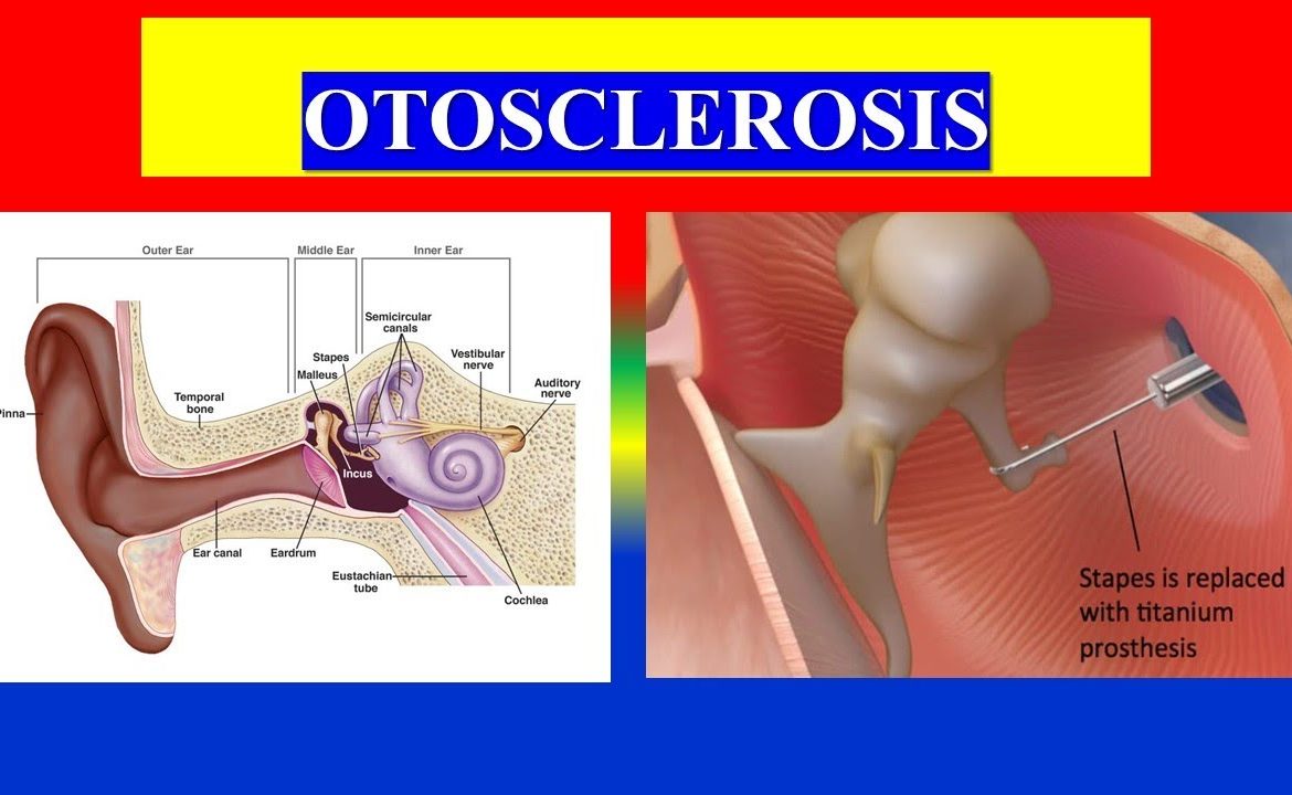 otosclerosis