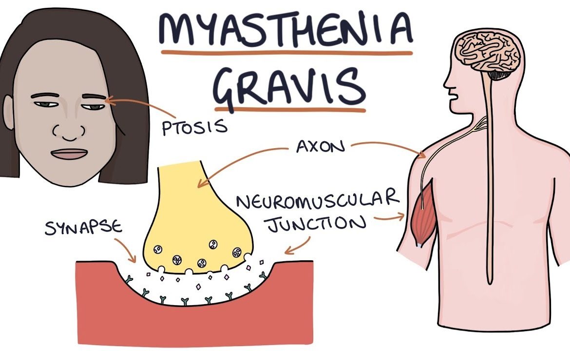 MYASTHENIA GRAVIS