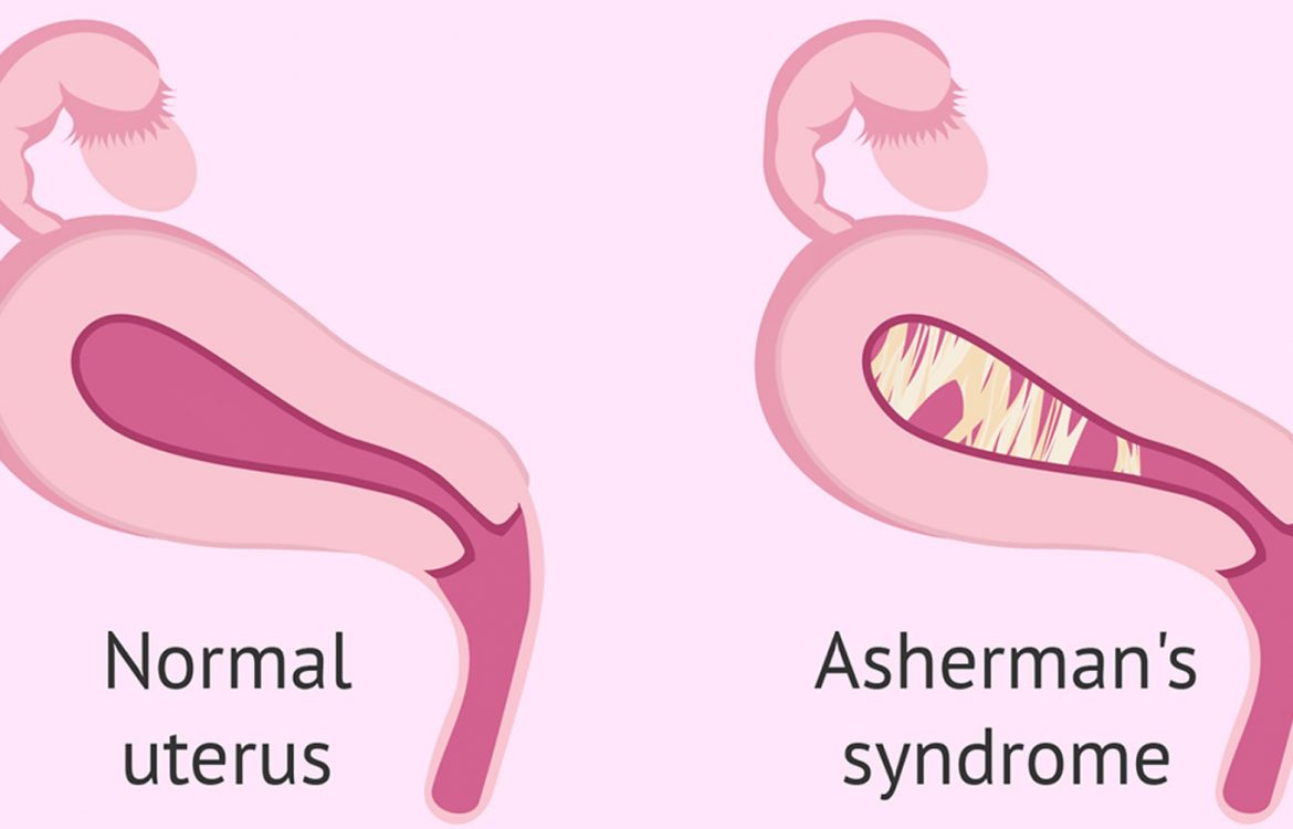 asherman-syndrome