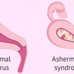 asherman-syndrome