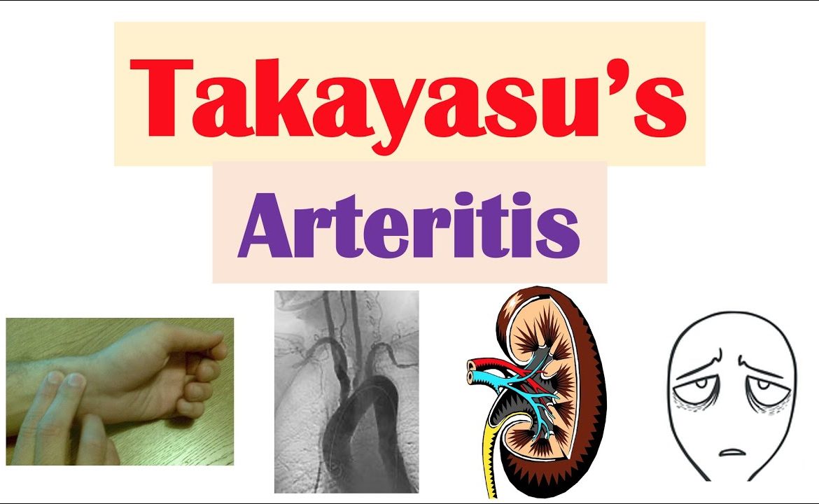 takayasu arthritis