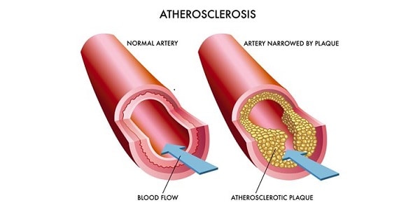 Atherosclerosis