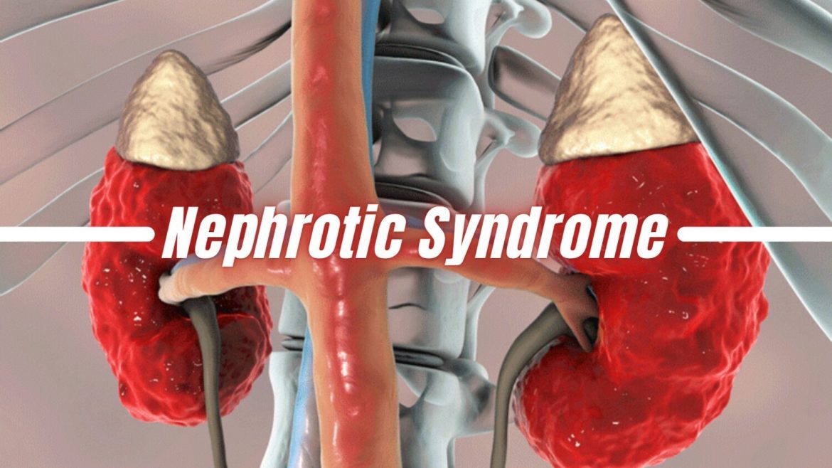 Nephrotic-syndrome