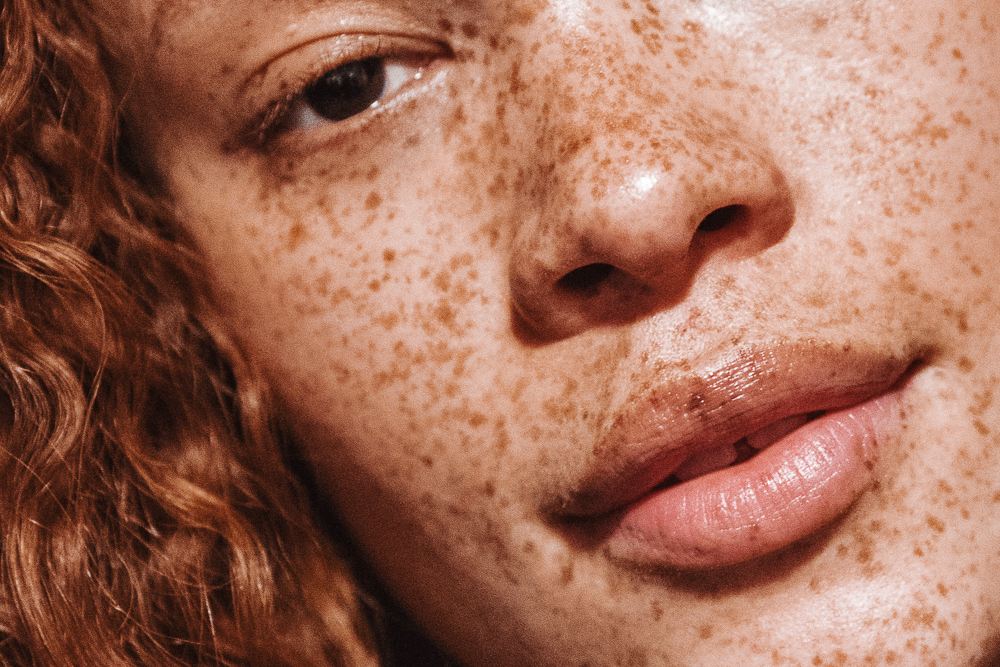 freckles